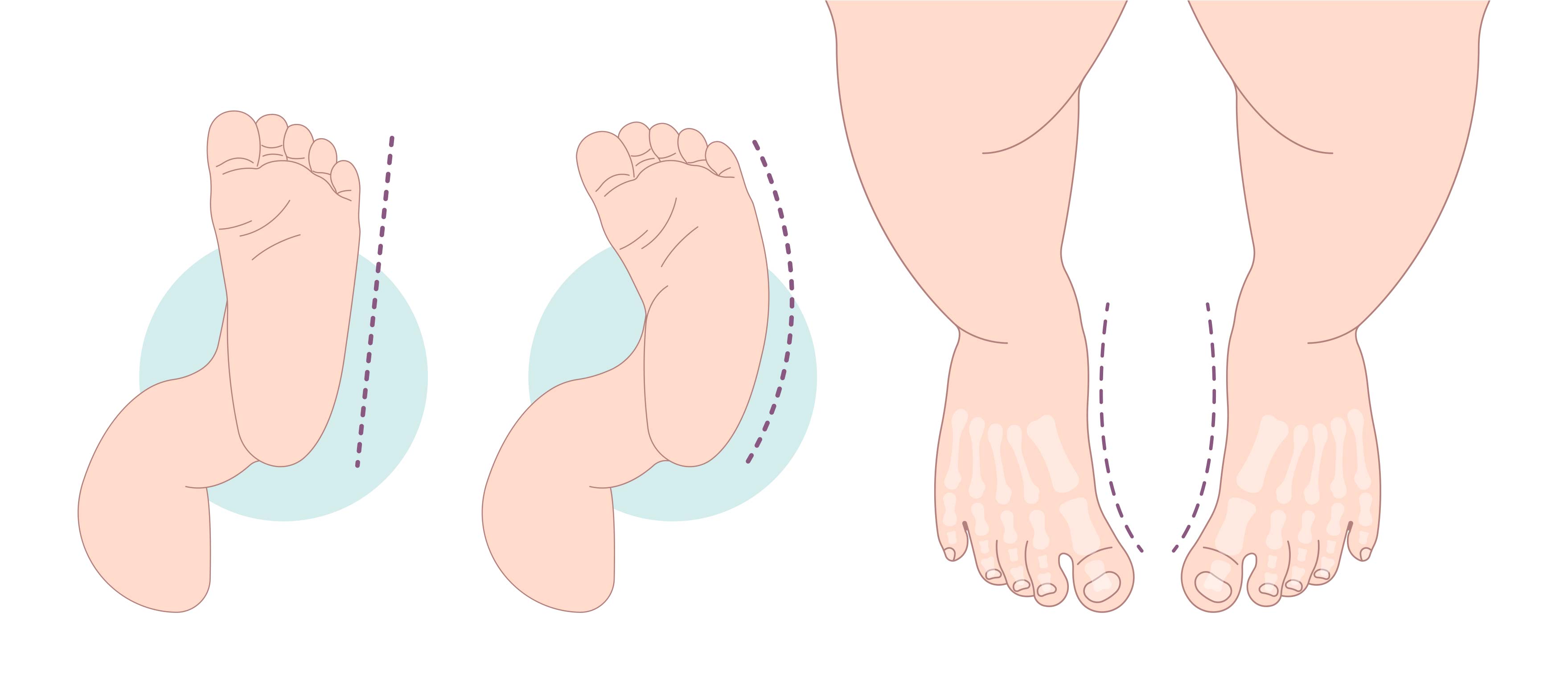 prosagogi prosthiou podos forefoot adductus inside