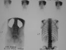                    bone scan