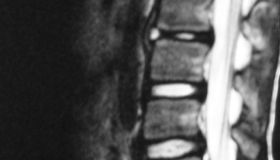 mri 