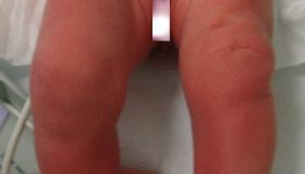 assymetric thigh skin folds left