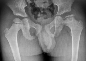 Οστεοχονδρίτιδα μηριαίας κεφαλής (Νόσος Legg-Calve-Perthes)