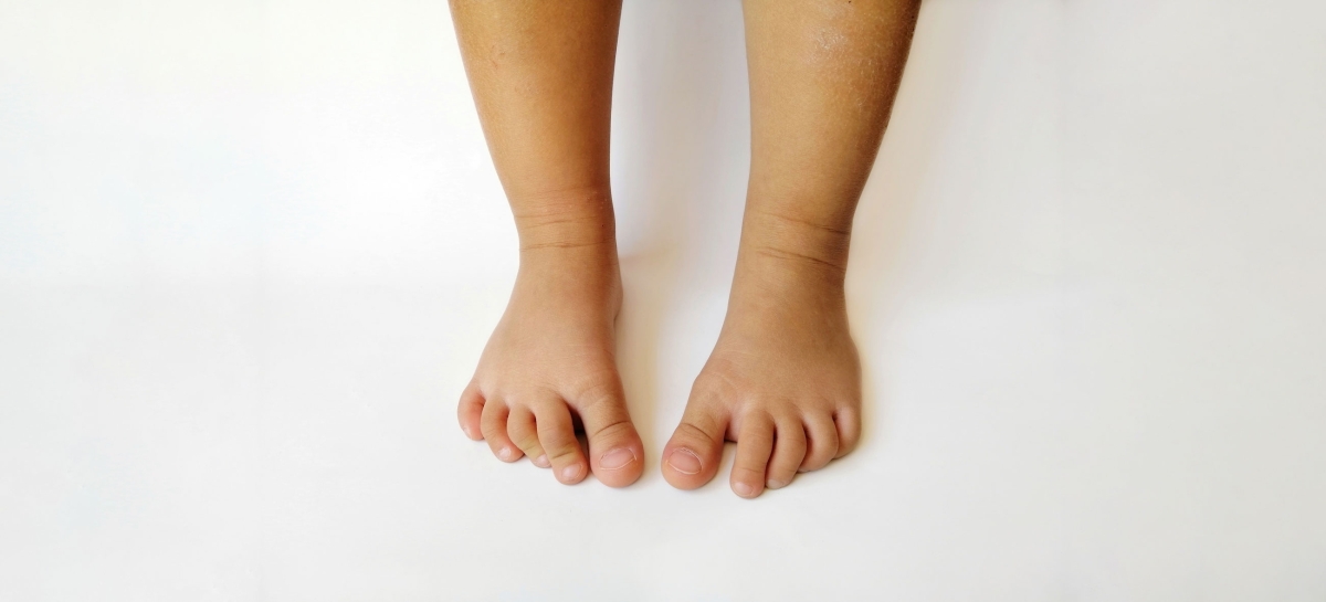 Προσαγωγή προσθίου ποδός (forefoot adductus)
