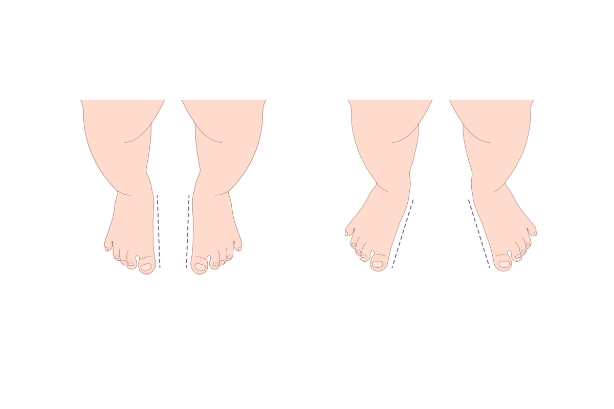 Βάδιση με έξω στροφή (Out-Toeing)