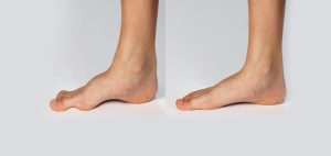 Κοιλοποδία (Cavus Foot)